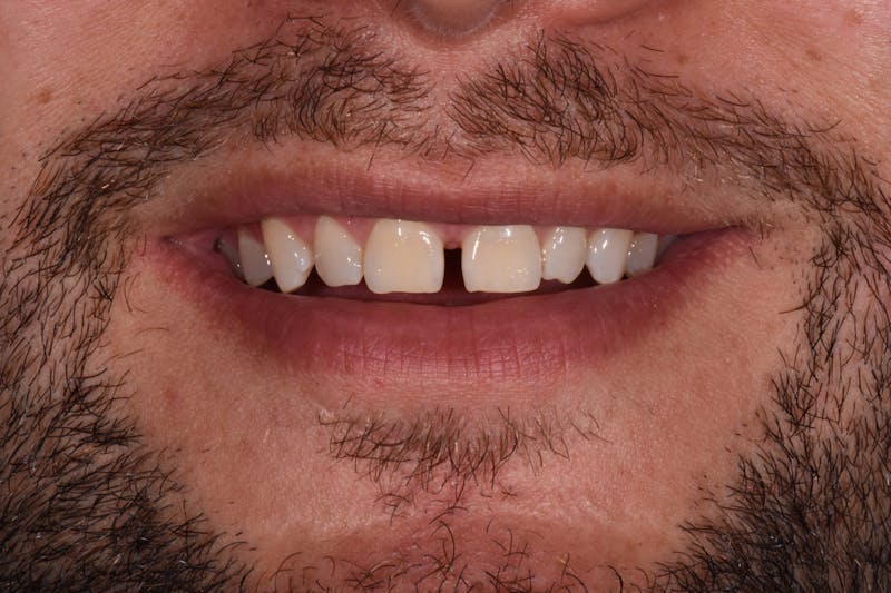 Patient Smile Before & After Gallery - Patient 396031 - Image 3