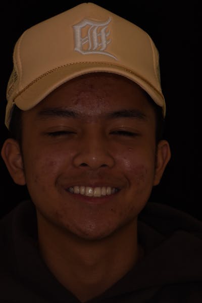 Patient Smile Before & After Gallery - Patient 413493 - Image 1