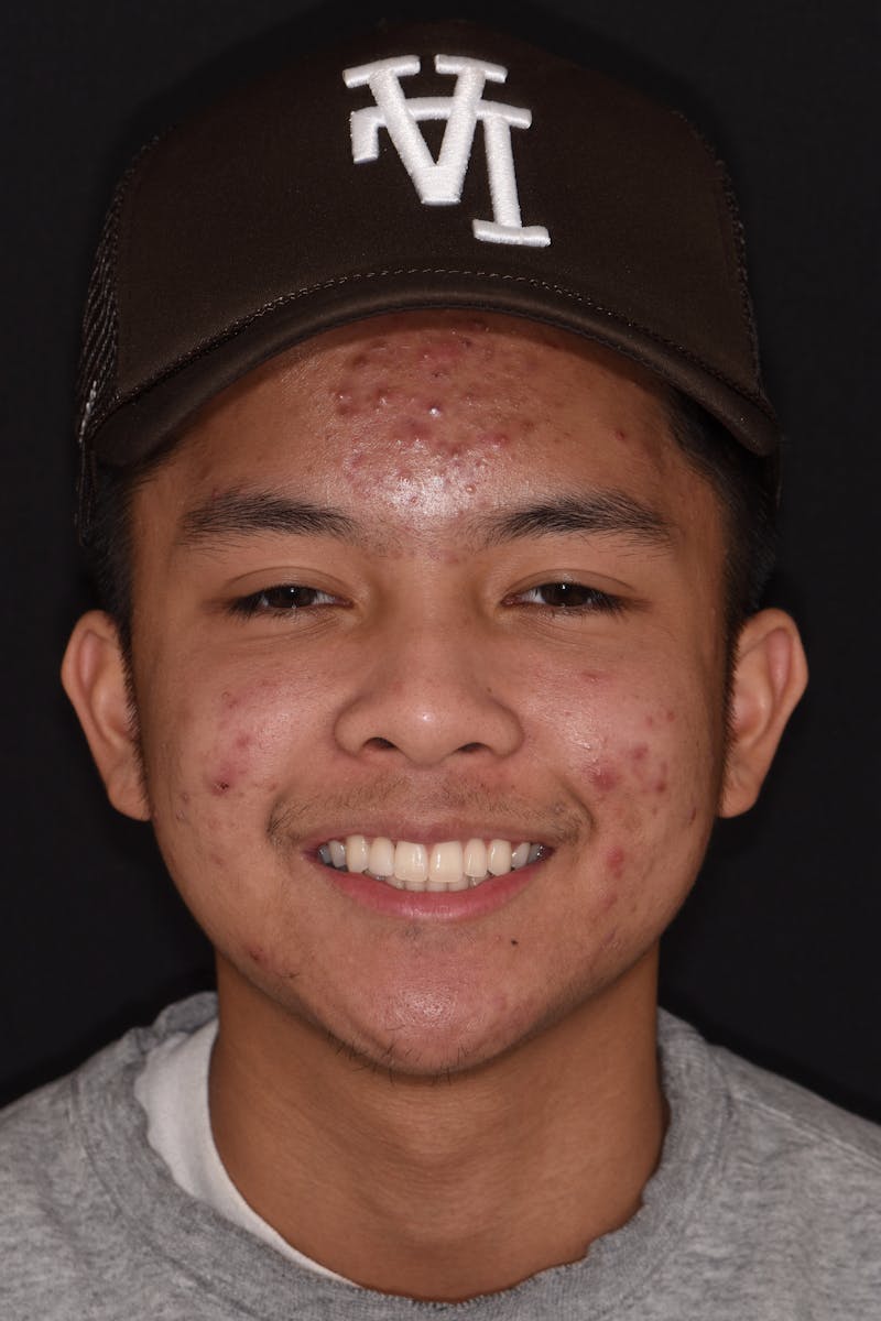 Patient Smile Before & After Gallery - Patient 413493 - Image 2