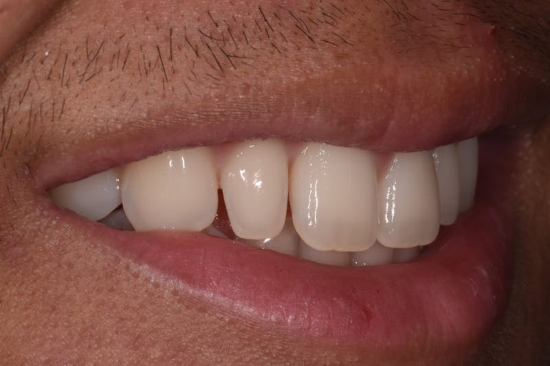 Patient Smile Before & After Gallery - Patient 413493 - Image 3
