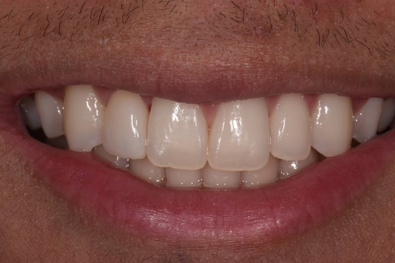 Patient Smile Before & After Gallery - Patient 413493 - Image 6