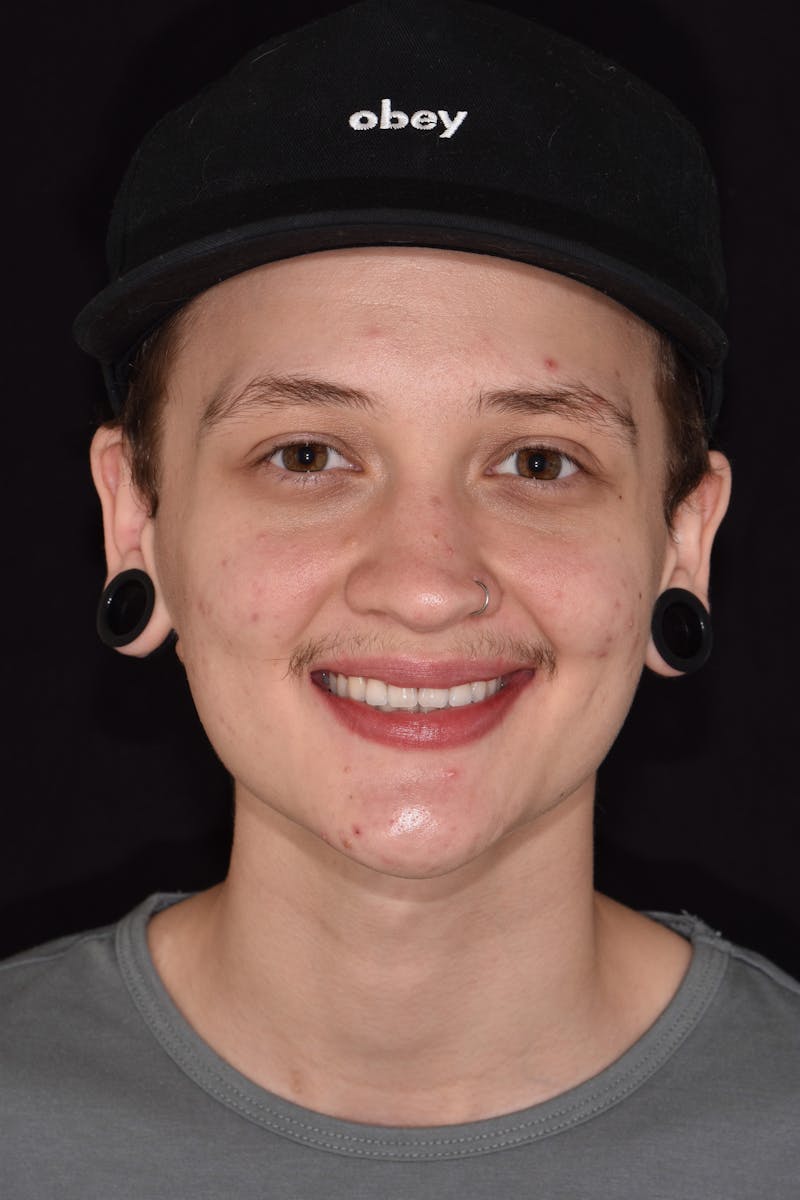 Patient Smile Before & After Gallery - Patient 349216 - Image 1
