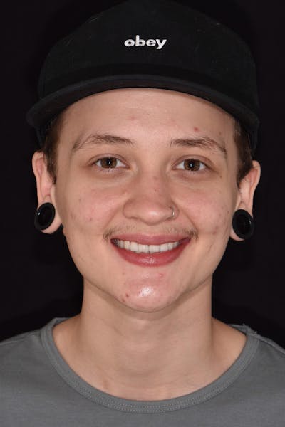 Patient Smile Before & After Gallery - Patient 349216 - Image 1