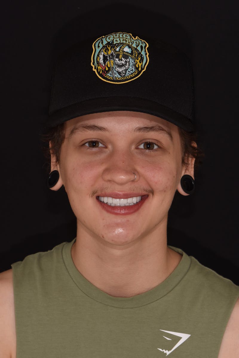 Patient Smile Before & After Gallery - Patient 349216 - Image 2