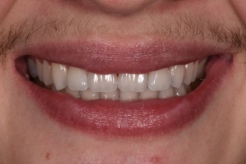Patient Smile Before & After Gallery - Patient 349216 - Image 3