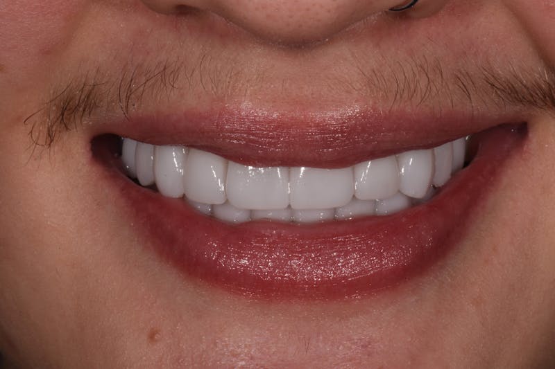 Patient Smile Before & After Gallery - Patient 349216 - Image 4