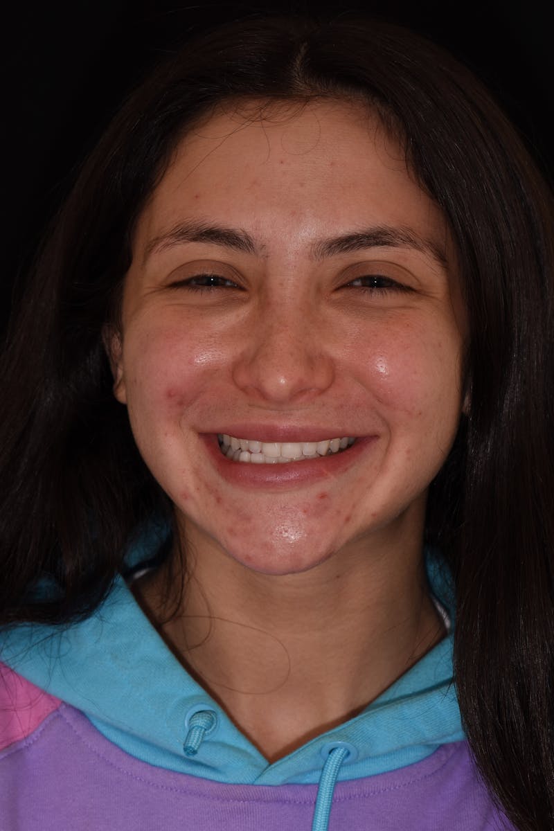 Patient Smile Before & After Gallery - Patient 323208 - Image 1