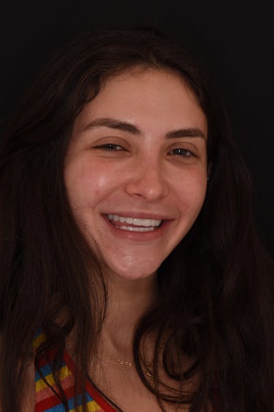 Patient Smile Before & After Gallery - Patient 323208 - Image 2