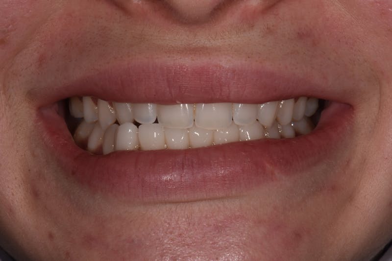 Patient Smile Before & After Gallery - Patient 323208 - Image 3