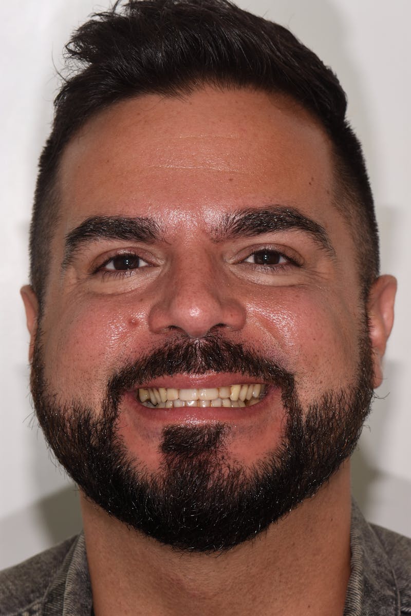 Patient Smile Before & After Gallery - Patient 426162 - Image 1