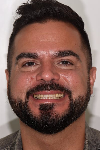 Patient Smile Before & After Gallery - Patient 426162 - Image 1