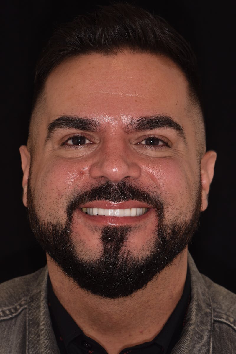 Patient Smile Before & After Gallery - Patient 426162 - Image 2