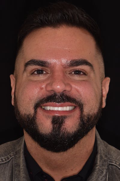 Patient Smile Before & After Gallery - Patient 426162 - Image 2