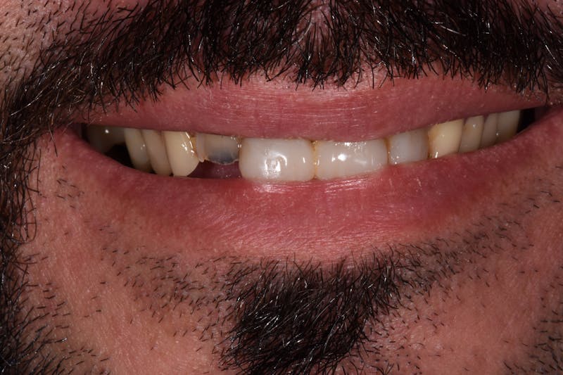 Patient Smile Before & After Gallery - Patient 426162 - Image 3