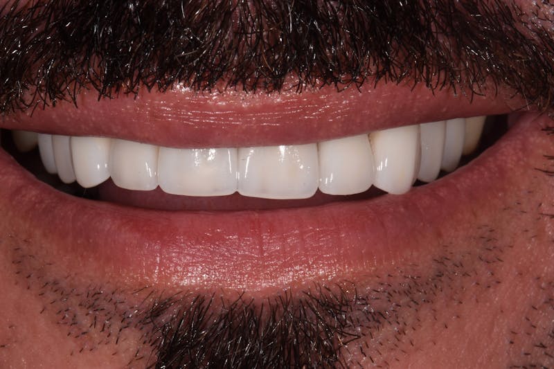 Patient Smile Before & After Gallery - Patient 426162 - Image 4