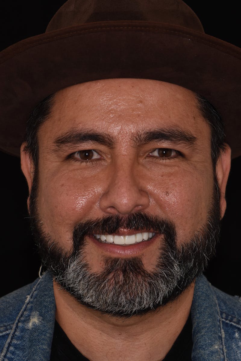 Patient Smile Before & After Gallery - Patient 408529 - Image 2