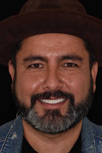 Patient Smile Before & After Gallery - Patient 408529 - Image 2