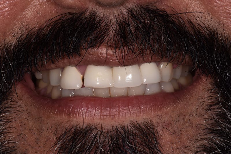 Patient Smile Before & After Gallery - Patient 408529 - Image 3