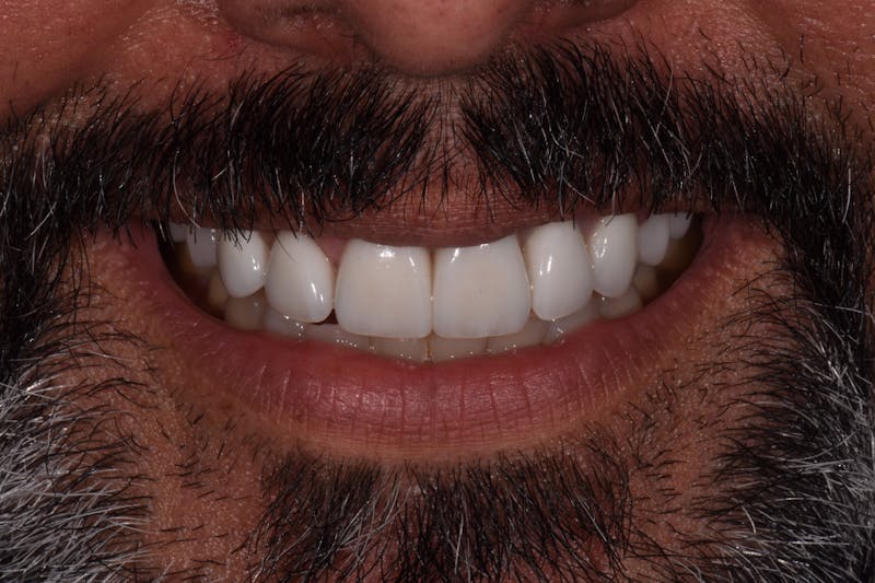 Patient Smile Before & After Gallery - Patient 408529 - Image 4