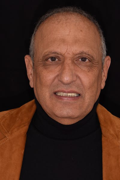 Patient Smile Before & After Gallery - Patient 532552 - Image 1