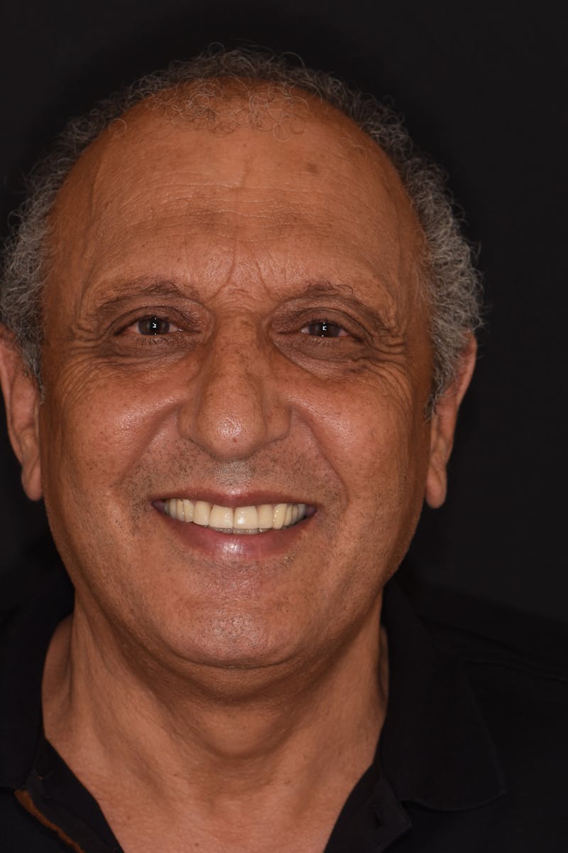 Patient Smile Before & After Gallery - Patient 532552 - Image 2