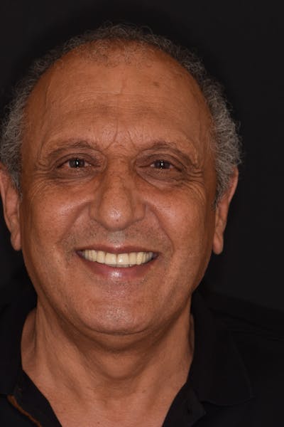 Patient Smile Before & After Gallery - Patient 532552 - Image 2