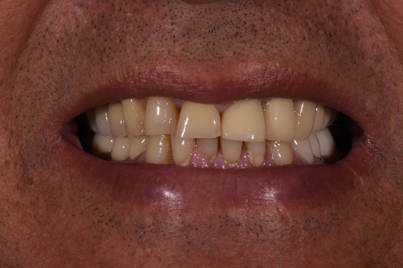 Patient Smile Before & After Gallery - Patient 532552 - Image 3