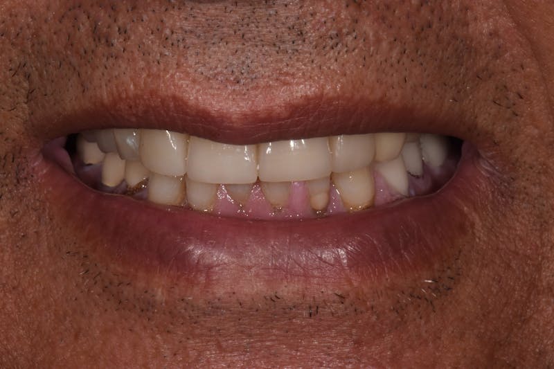 Patient Smile Before & After Gallery - Patient 532552 - Image 4