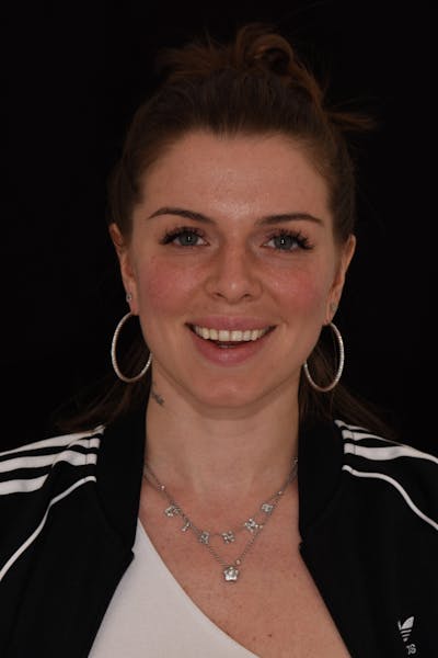 Patient Smile Before & After Gallery - Patient 370619 - Image 1