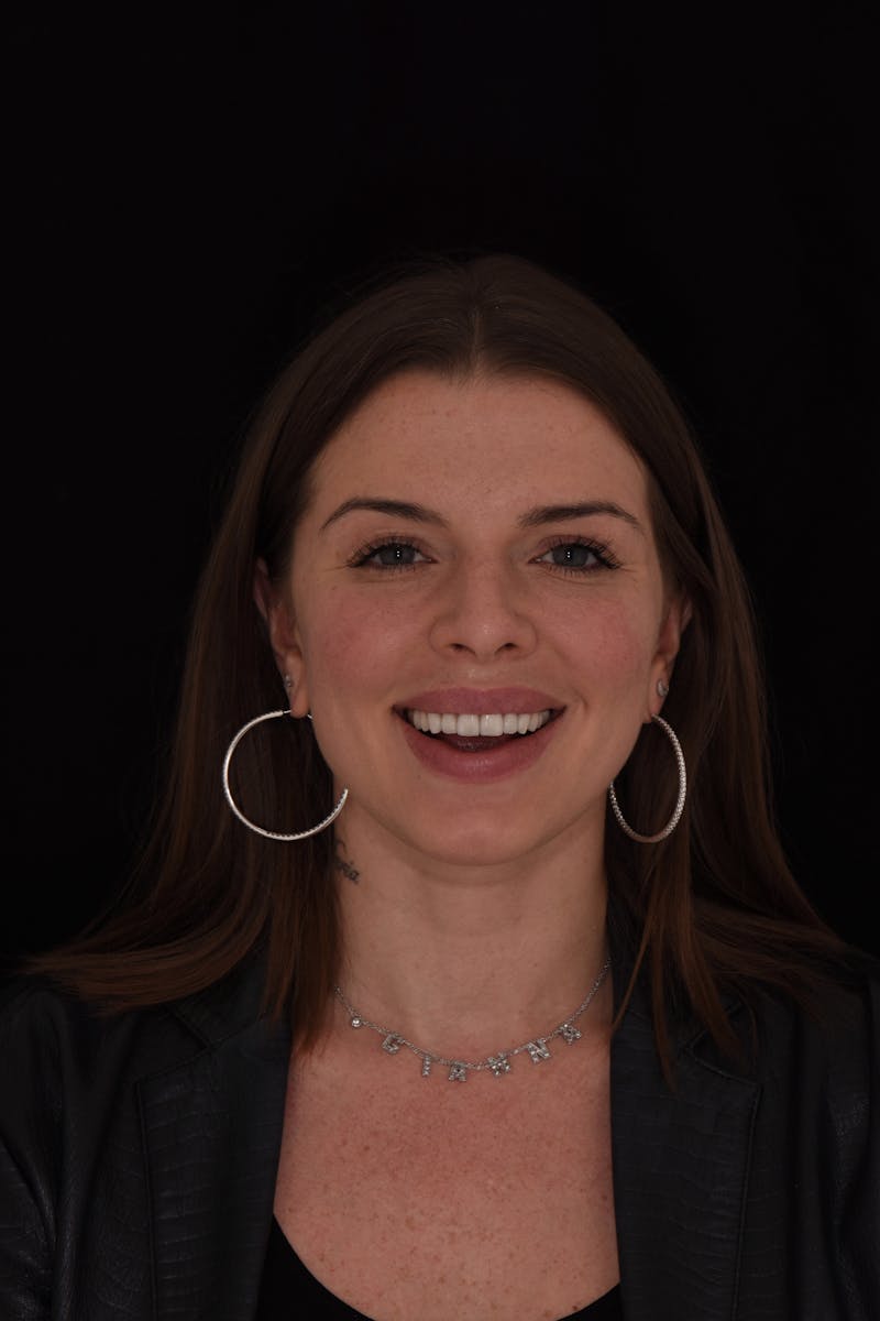 Patient Smile Before & After Gallery - Patient 370619 - Image 2