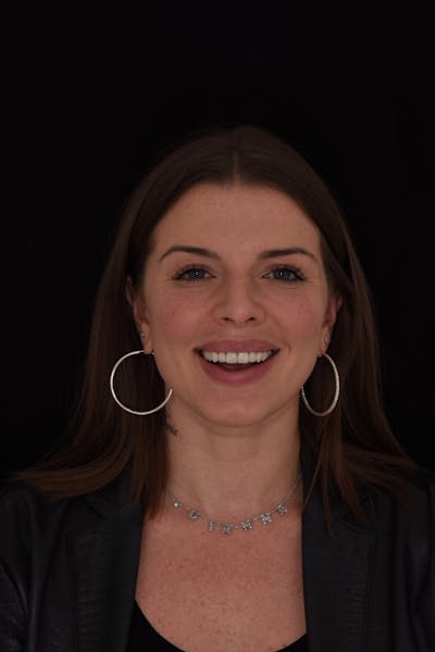 Patient Smile Before & After Gallery - Patient 370619 - Image 2