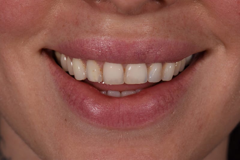 Patient Smile Before & After Gallery - Patient 370619 - Image 3