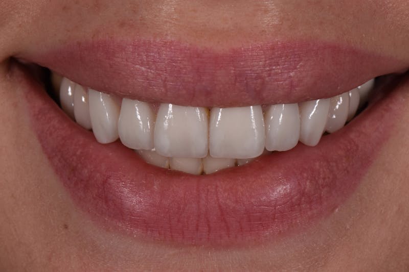 Patient Smile Before & After Gallery - Patient 370619 - Image 4