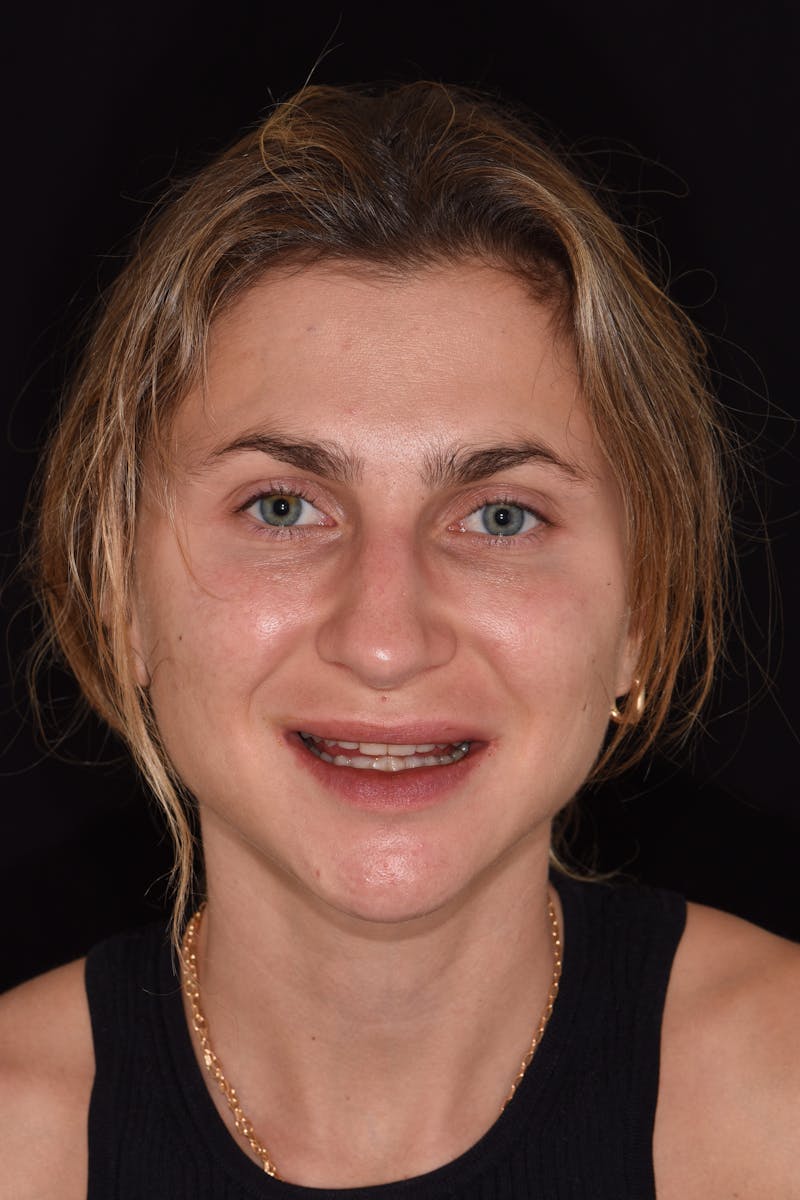 Patient Smile Before & After Gallery - Patient 255385 - Image 1