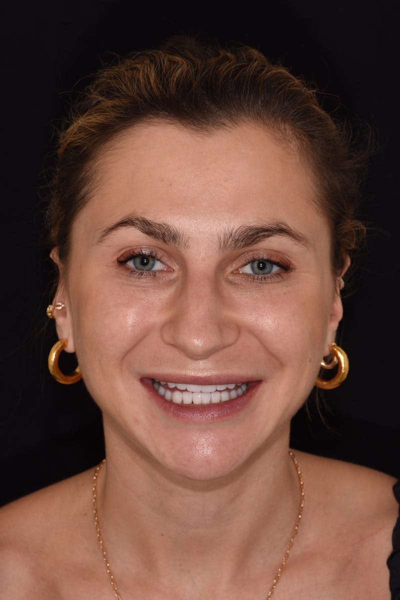 Patient Smile Before & After Gallery - Patient 255385 - Image 2