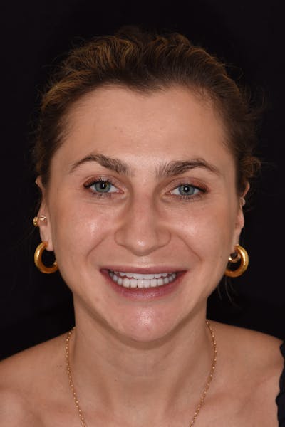 Patient Smile Before & After Gallery - Patient 255385 - Image 2