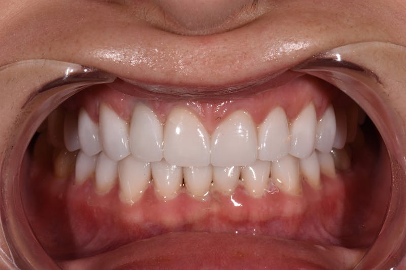 Patient Smile Before & After Gallery - Patient 255385 - Image 4