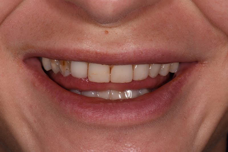 Patient Smile Before & After Gallery - Patient 255385 - Image 5