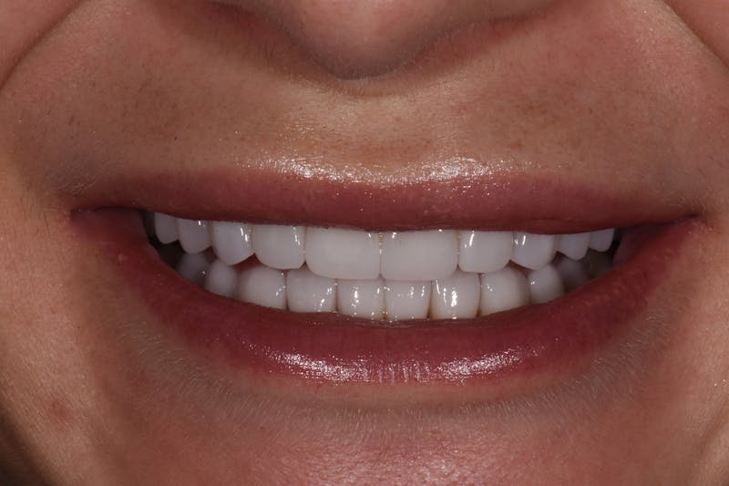 Patient Smile Before & After Gallery - Patient 255385 - Image 6
