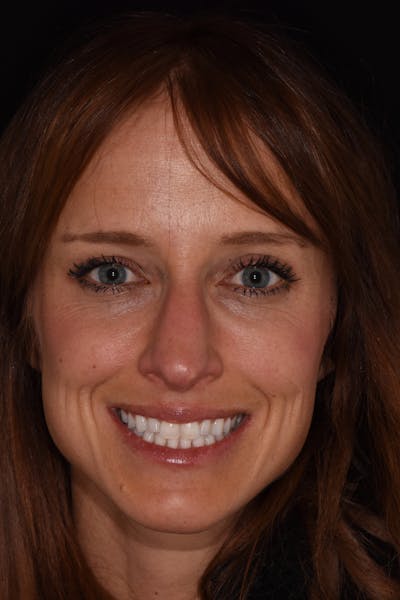 Patient Smile Before & After Gallery - Patient 307037 - Image 1