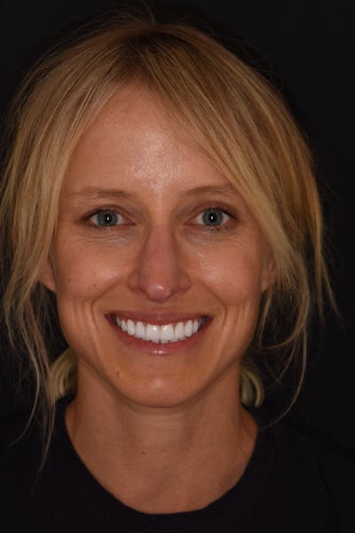 Patient Smile Before & After Gallery - Patient 307037 - Image 2