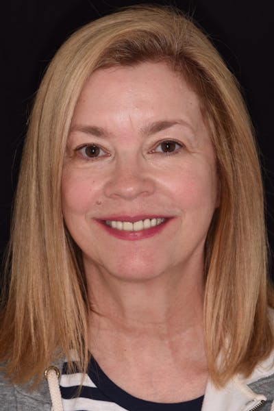 Patient Smile Before & After Gallery - Patient 139495 - Image 1