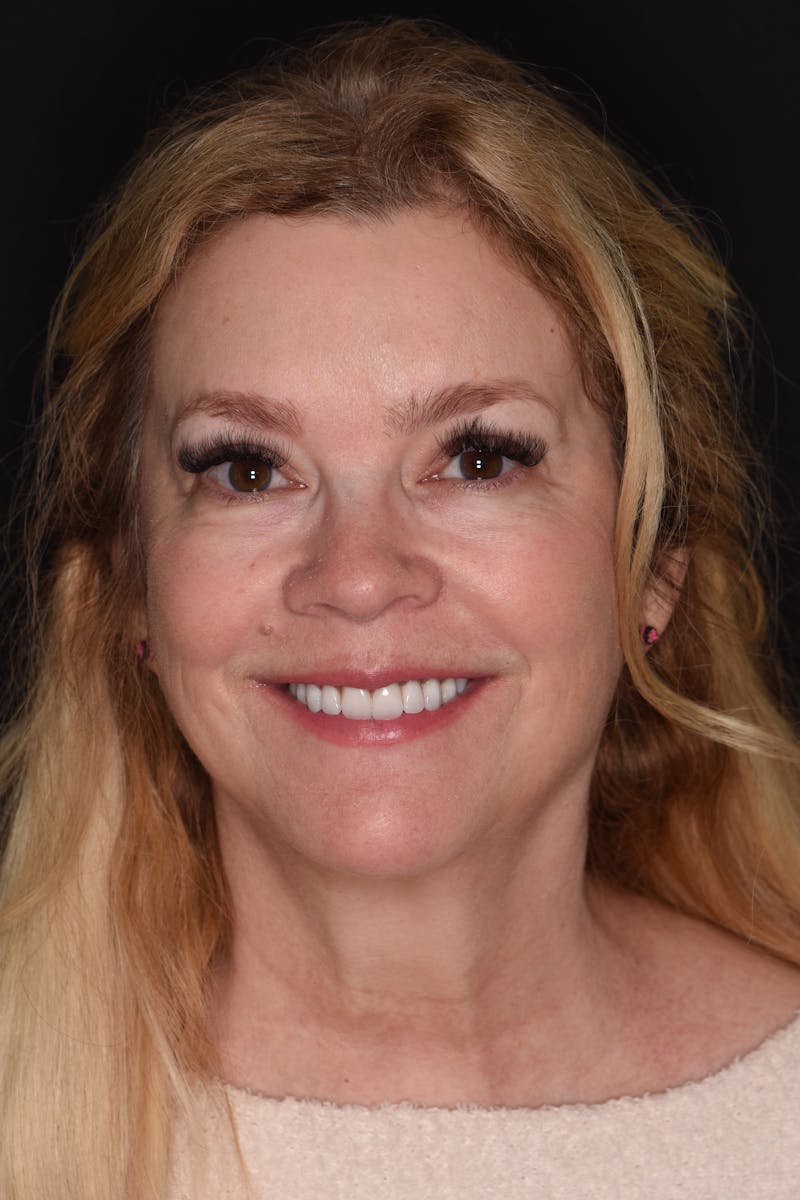 Patient Smile Before & After Gallery - Patient 139495 - Image 2