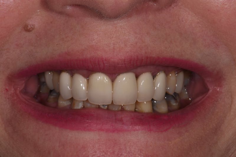 Patient Smile Before & After Gallery - Patient 139495 - Image 3