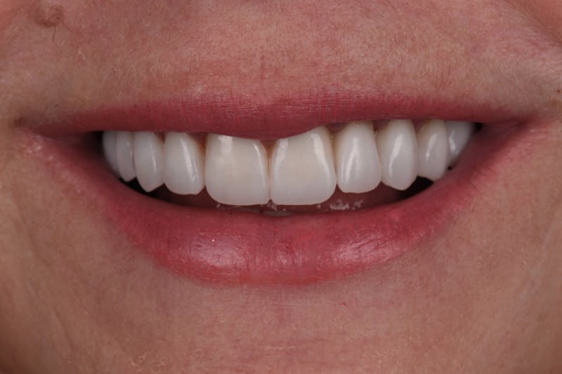 Patient Smile Before & After Gallery - Patient 139495 - Image 4