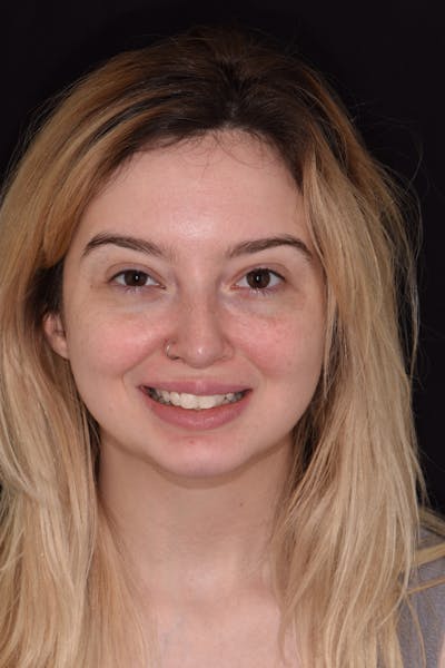 Patient Smile Before & After Gallery - Patient 148154 - Image 1