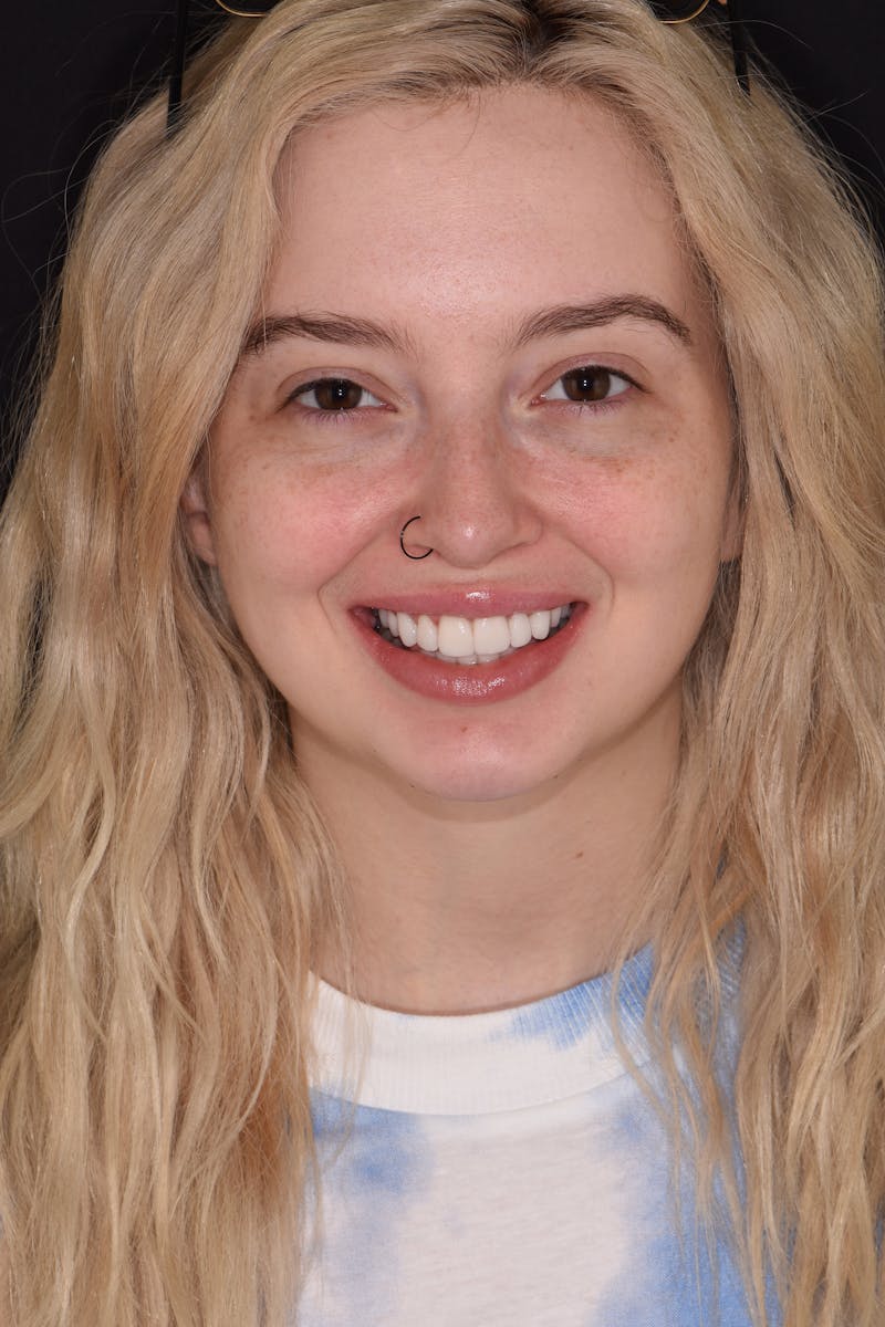 Patient Smile Before & After Gallery - Patient 148154 - Image 2