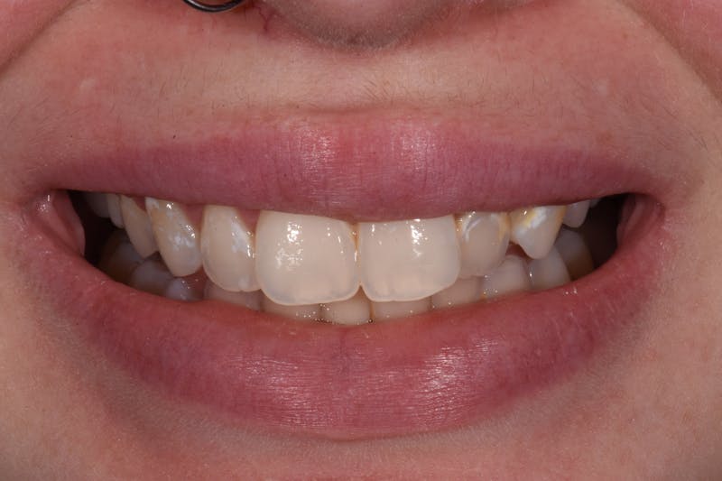 Patient Smile Before & After Gallery - Patient 148154 - Image 3
