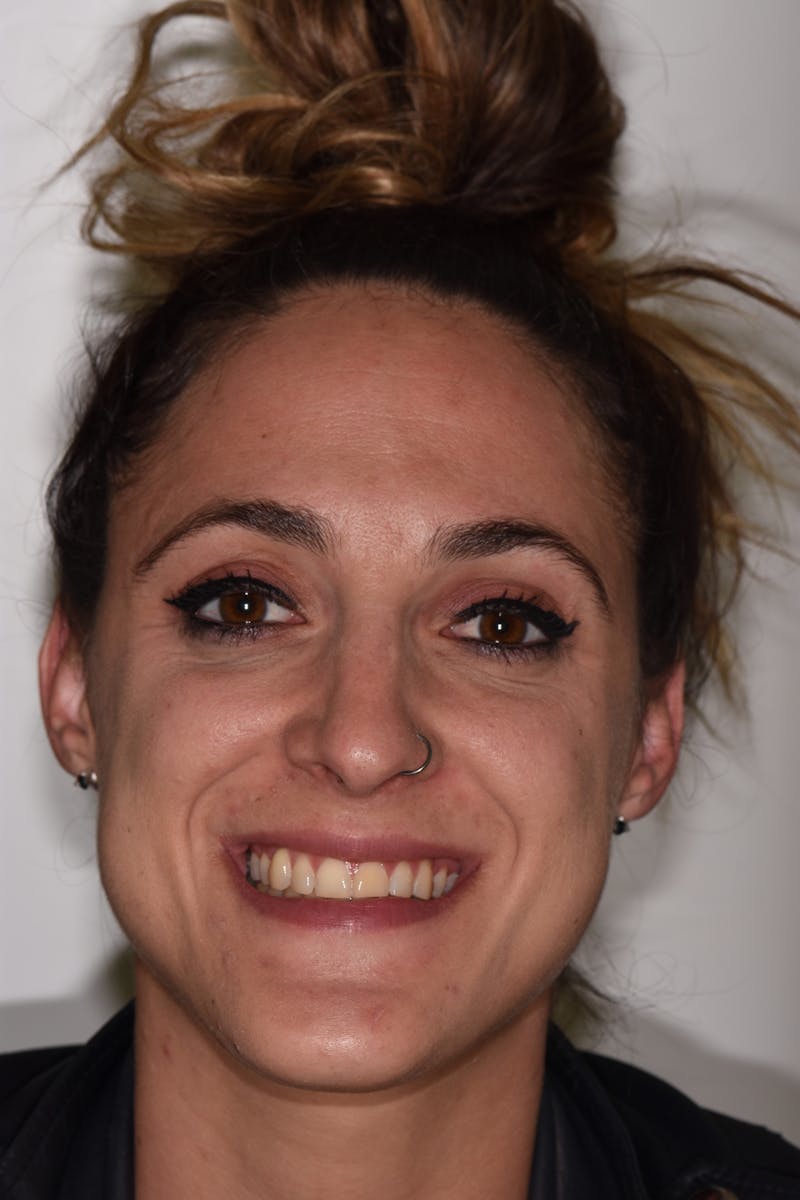 Patient Smile Before & After Gallery - Patient 176655 - Image 1