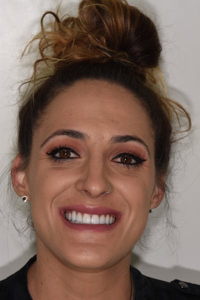 Patient Smile Before & After Gallery - Patient 176655 - Image 2